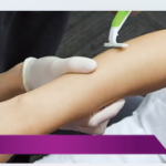 施術前に、施術部位の剃り残しを処理し、 マーキングを行います。